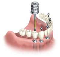 UploadImage/73544Dental bridge.jpg